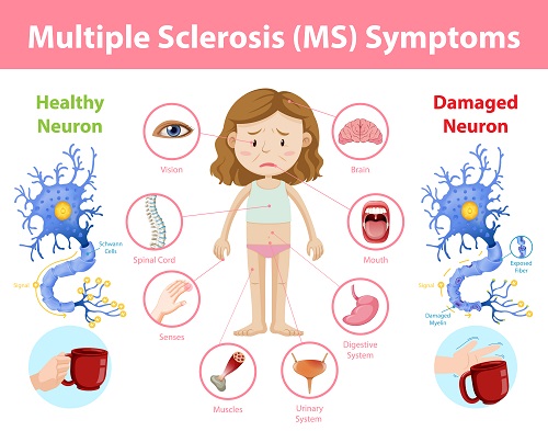 Multiple Sclerosis And Important Multiple Sclerosis Symptoms