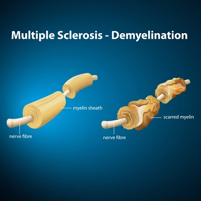 Multiple Sclerosis And Important Multiple Sclerosis Symptoms